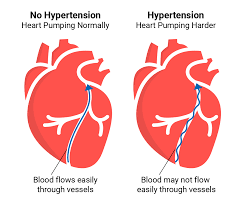 Hypertension higher among educated, urban residents: Study