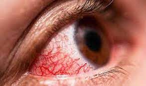 Eye-flu outbreak in Jammu; GMCH records over 11,500 cases