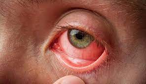Rise in Eye Flu Cases: Over 8,800 Cases Reported in Kashmir in the Last 2 Weeks
