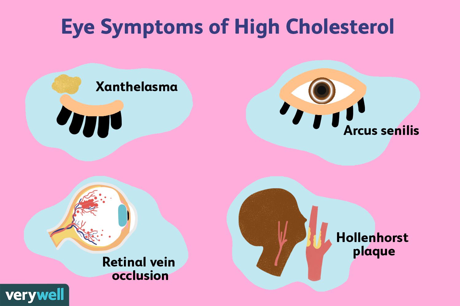 Check Your Body, Not Just Your Blood - Key Signs You Might Have High Cholesterol