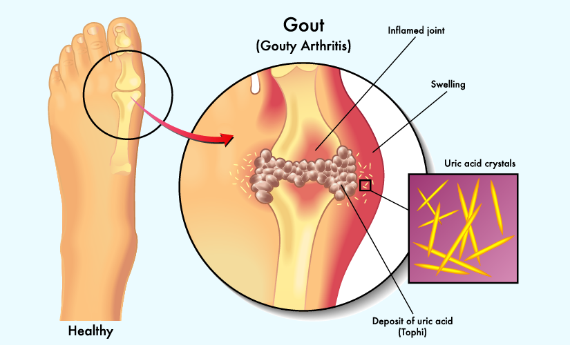 High Uric Acid - A Deep Dive into Symptoms, Causes, and Comprehensive Management