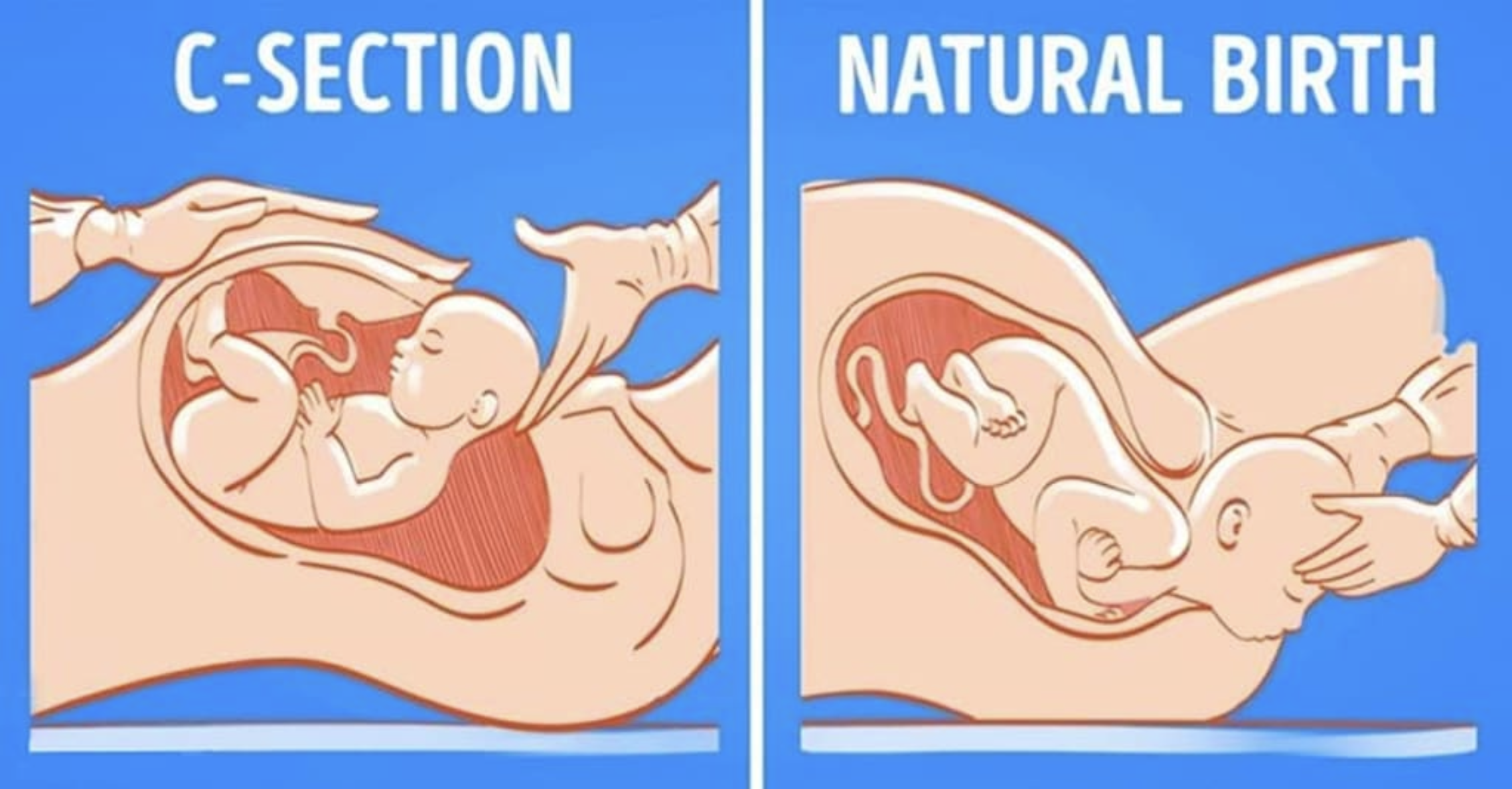 Birth by Blade - Kashmir's C-section Epidemic Threatens Mothers and Babies
