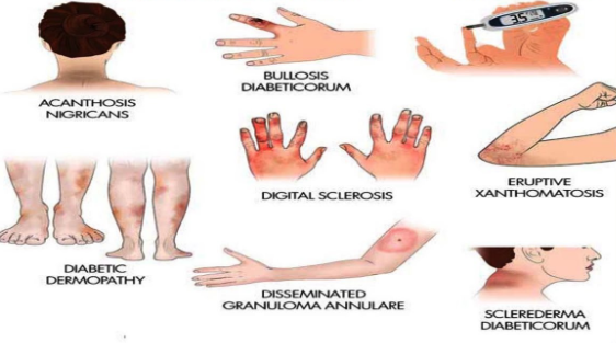 Diabetes and Your Skin: Unveiling the Hidden Clues