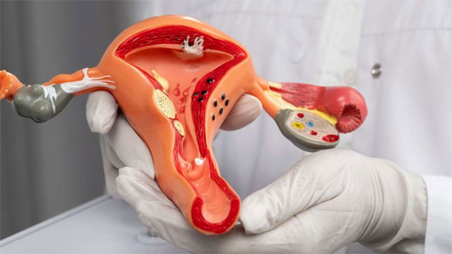 Health Alert: Spike in Gynaecological Cancers in Young Indian Women