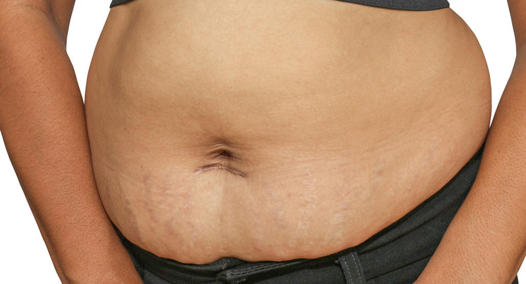 From Mom Tummy to Warrior Core: Your Science-Backed Guide to Postpartum Belly Transformation